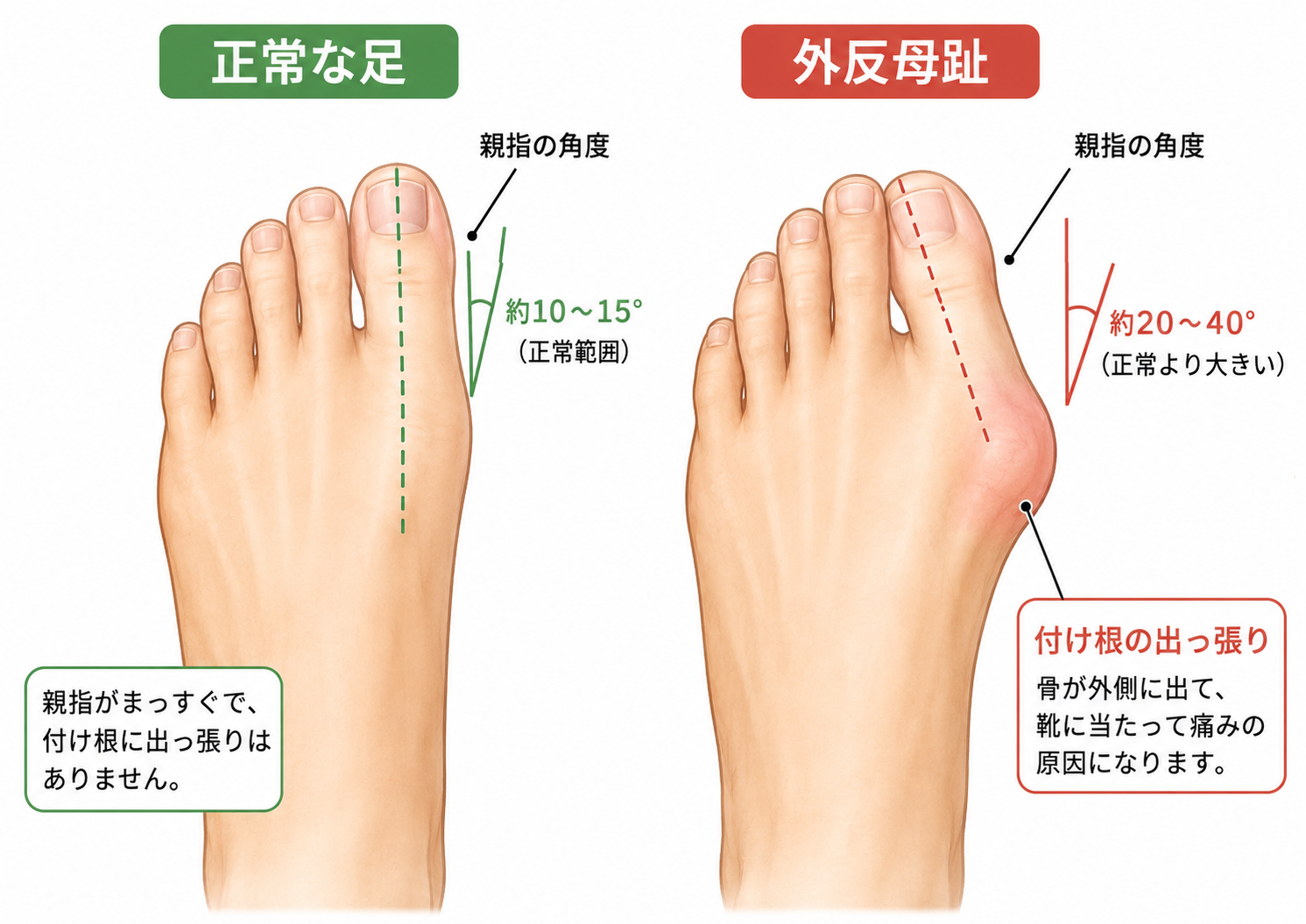 正常な足と外反母趾の比較。親指の角度と付け根の出っ張りの違いを示したイラスト
