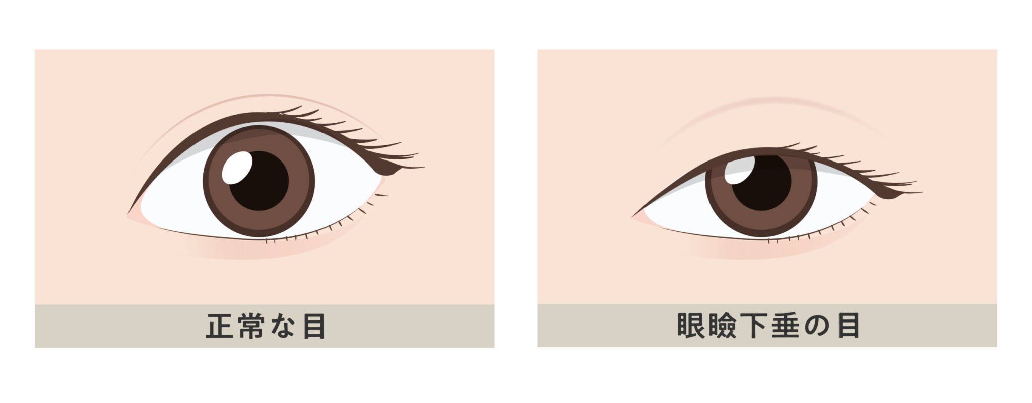 正常な目／眼瞼下垂の目