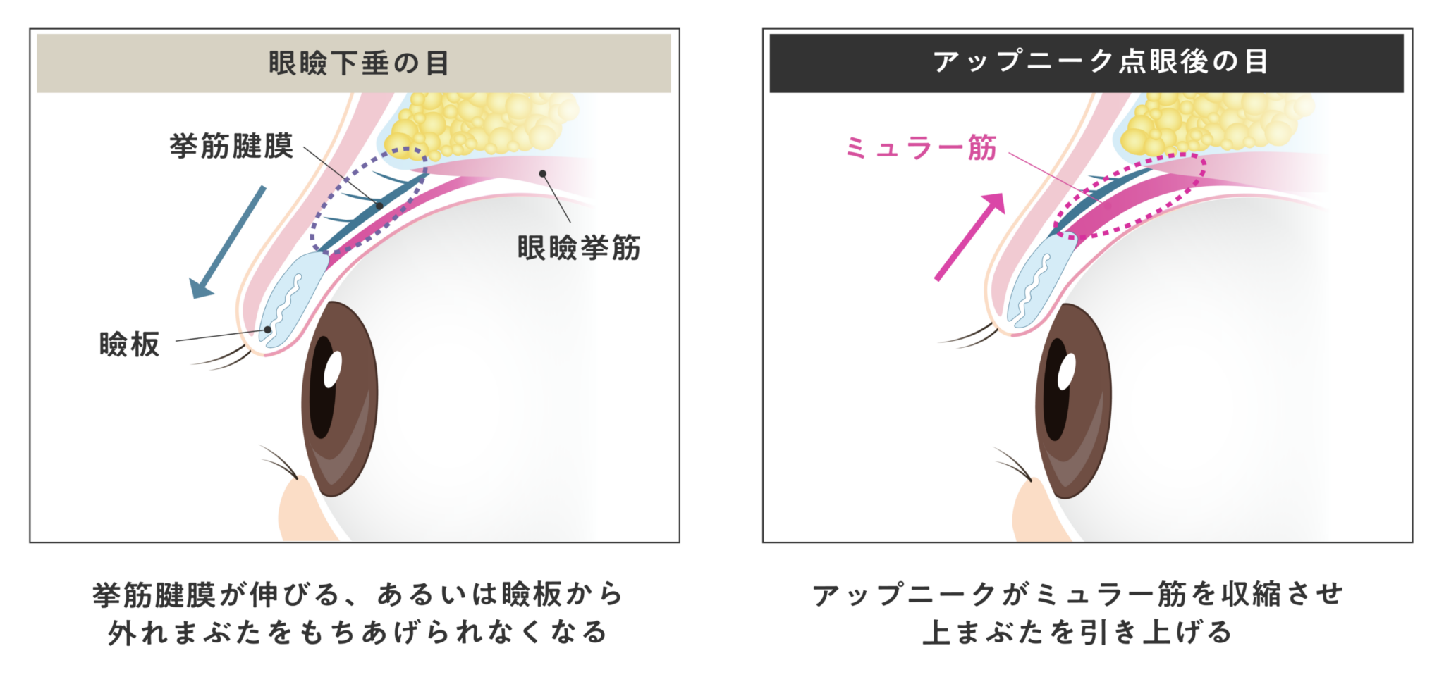眼瞼下垂の目／アップニーク点眼後の目の仕組み
