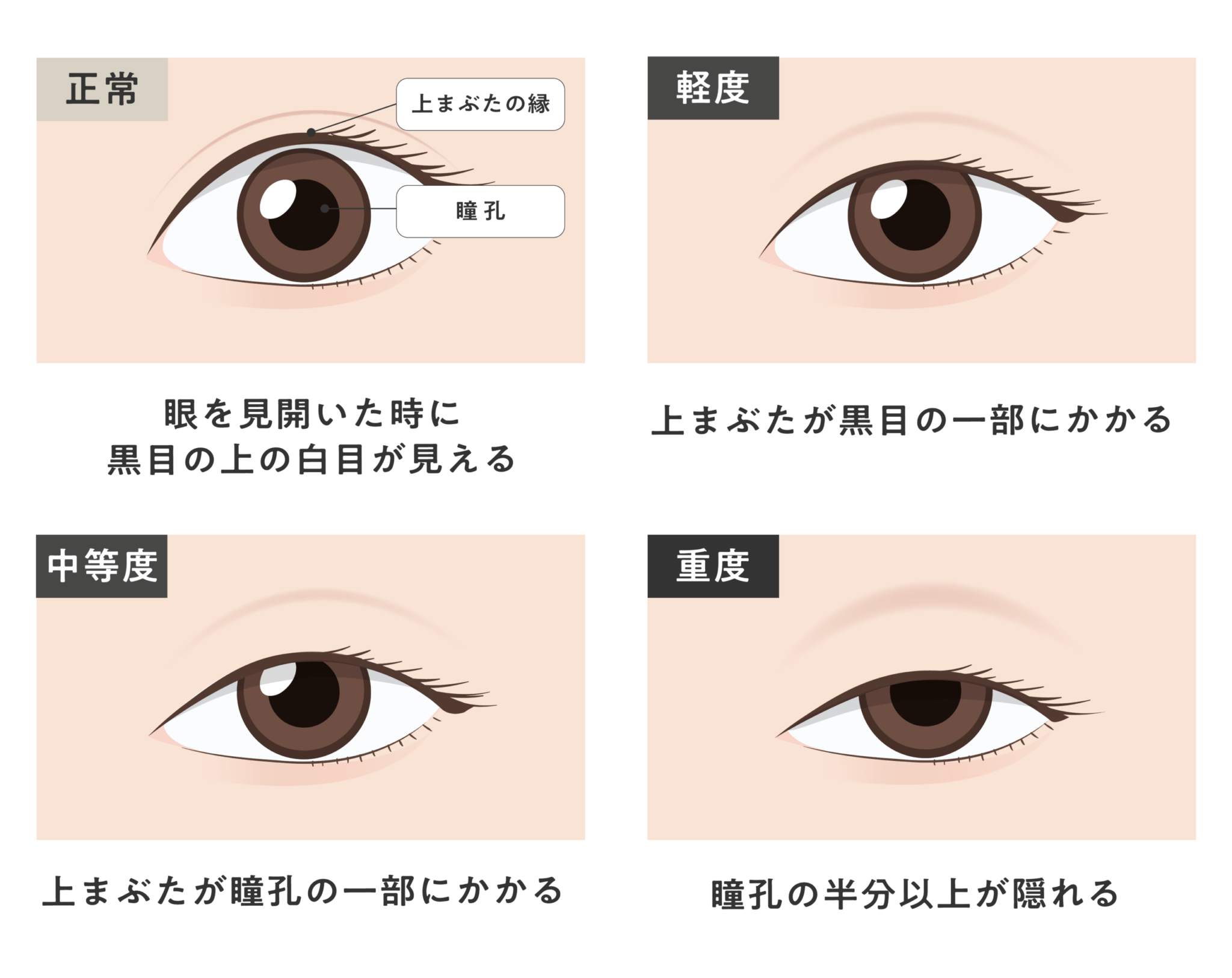眼瞼下垂の程度：正常／軽度／中等度／重度
