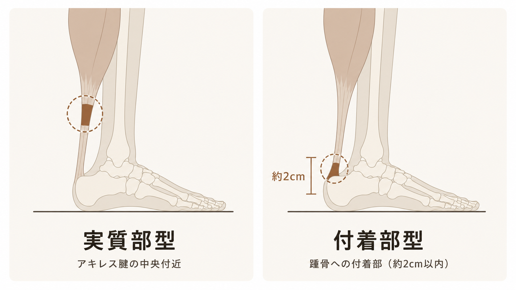 アキレス腱障害の実質部型と付着部型の違いを示した模式図