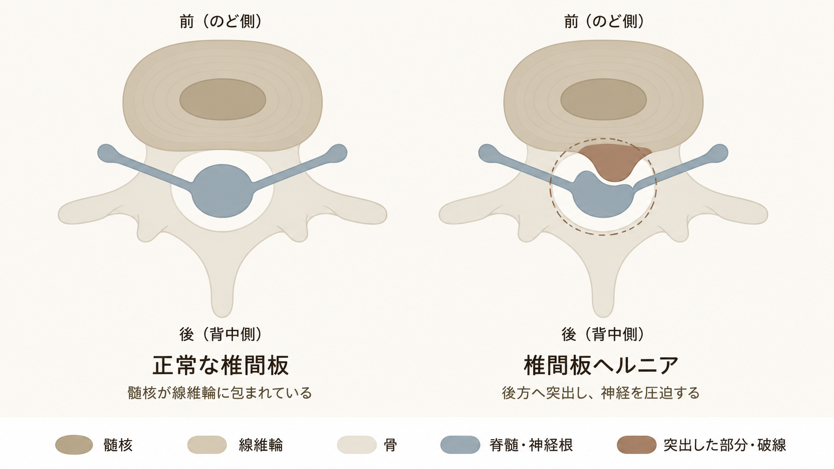 椎間板を上から見た模式図。左は正常な椎間板、右は後方へ突出して脊髄を圧迫している椎間板ヘルニア