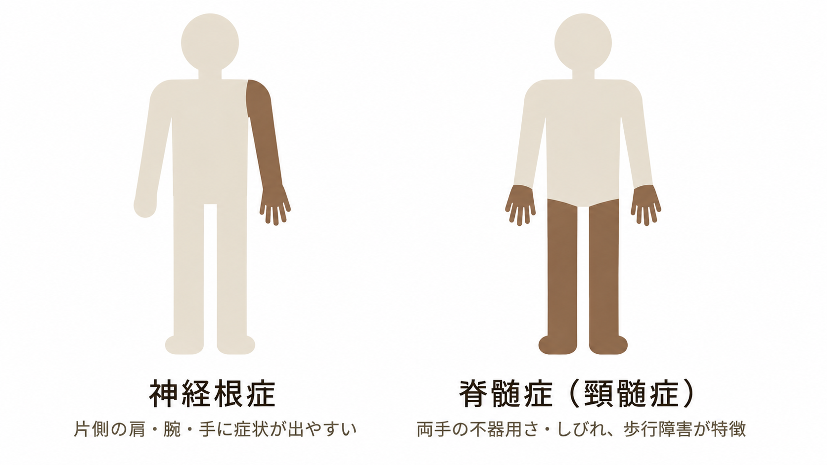神経根症は片側の肩・腕・手に、脊髄症は両手のしびれや歩行障害として症状が出やすいことを示した模式図
