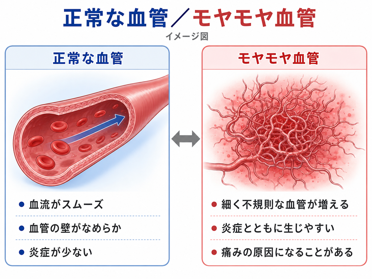 正常な血管とモヤモヤ血管の比較イメージ図