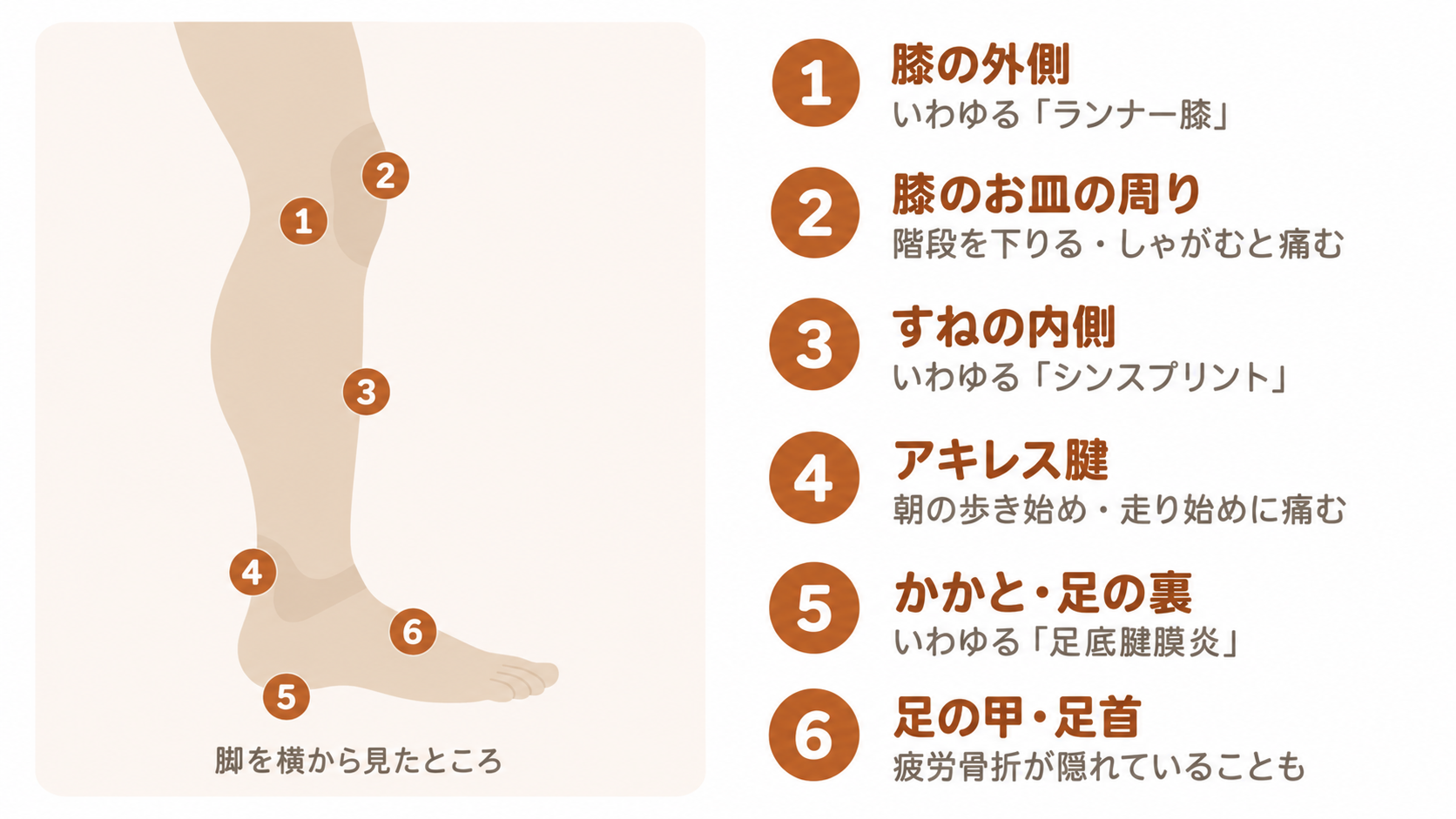 脚を横から見た模式図。膝の外側、膝のお皿の周り、すねの内側、アキレス腱、かかとと足の裏、足の甲と足首という6か所の、ランニングで痛みが出やすい場所