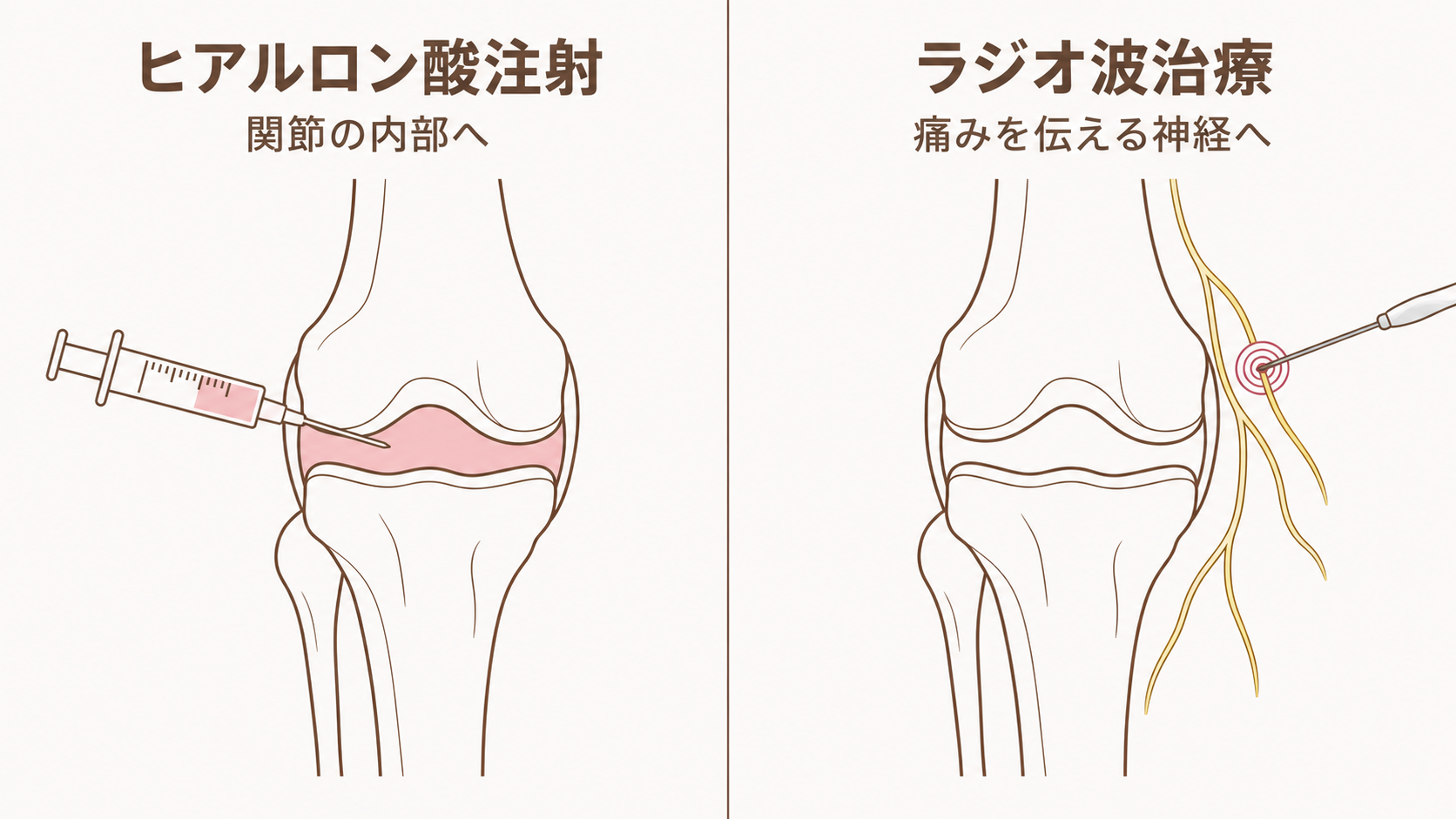 ヒアルロン酸注射とラジオ波治療が働きかける場所を左右で比較した図。左は関節の内部へ薬剤を注射し、右は関節の外を走る神経に電極を近づけている