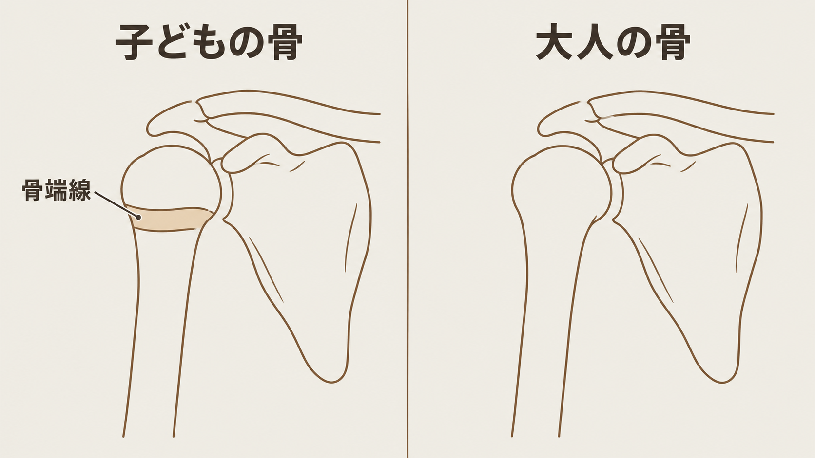 子どもの肩と大人の肩の骨を左右で比較した図。子どもの側には上腕骨の上の端に骨端線が描かれている